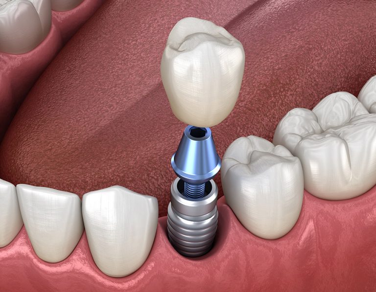 Implants-dentals-Mollerussa