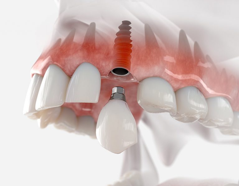 Implantologia-dental-Mollerussa