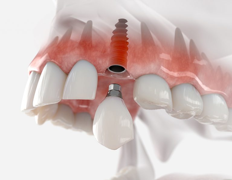 Que-son-els-implants-dentals