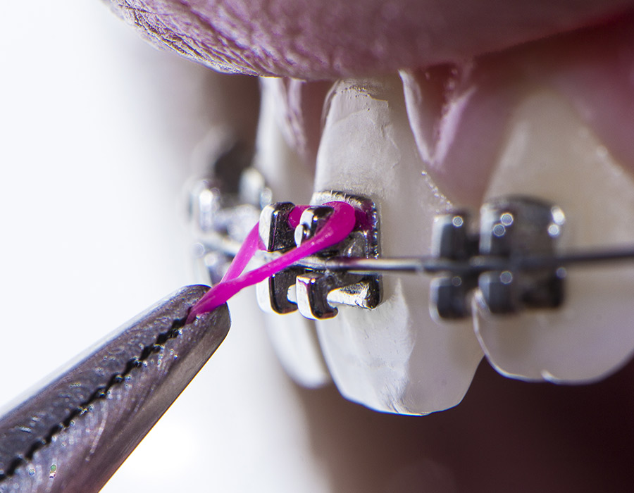 Arco Dentale Acciaio Inox Filamento Per Arco Ortodontico 0.99 - Acciaio Inossidabile, Forma Ovale/rettangolare Angolare Ferro Zincato